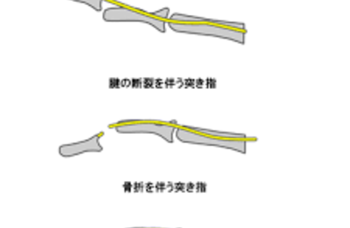 突き指の症状