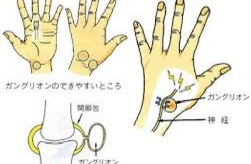 ガングリオン図